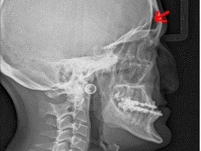 Hipoplasia Medio Facial