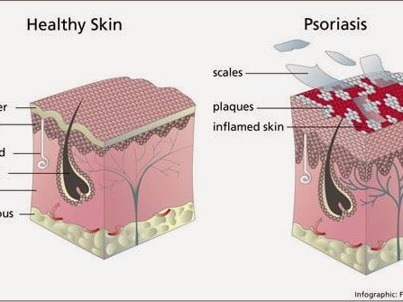 Efectos de la psoriasis