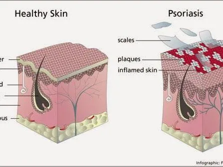 Efectos De La Psoriasis Efectos De La Psoriasis