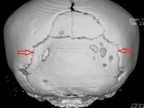 Fusion Prematura De Las Fontanelas Sindrome De Apert